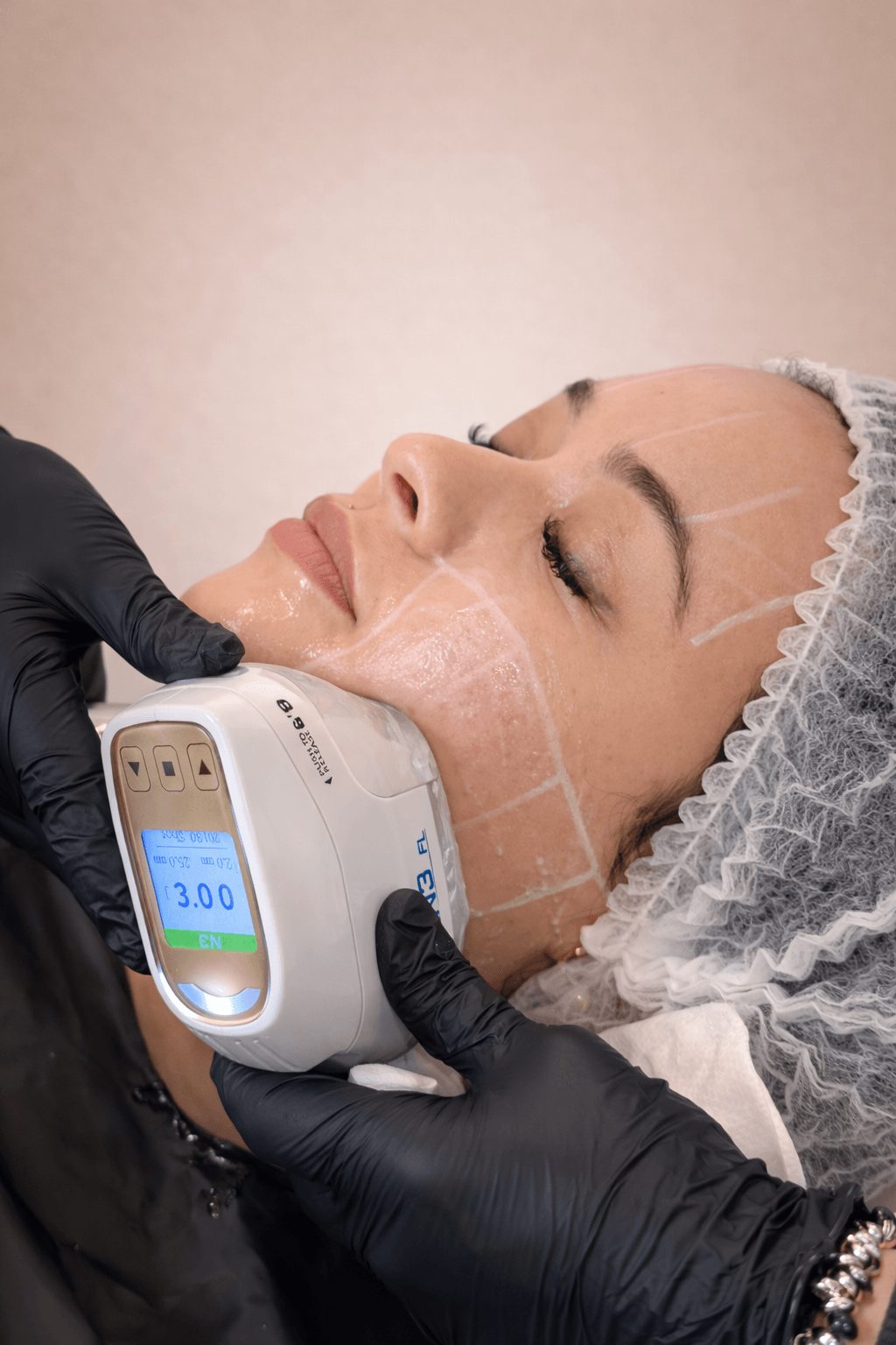 Lifting periorbital con ULTRALIFT